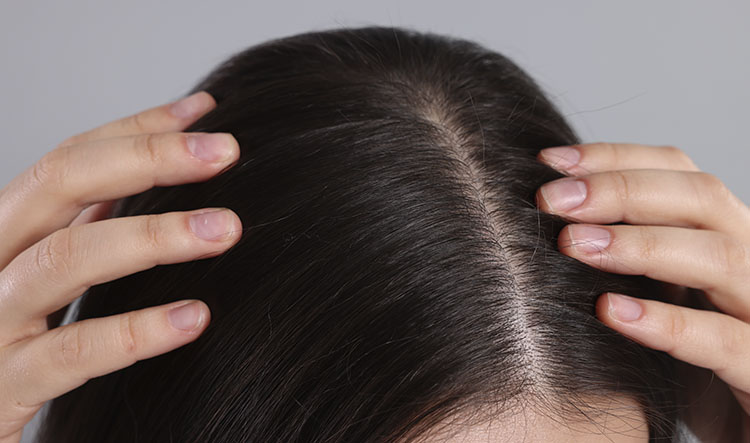 Как избавиться от перхоти на голове быстро и эффективно?