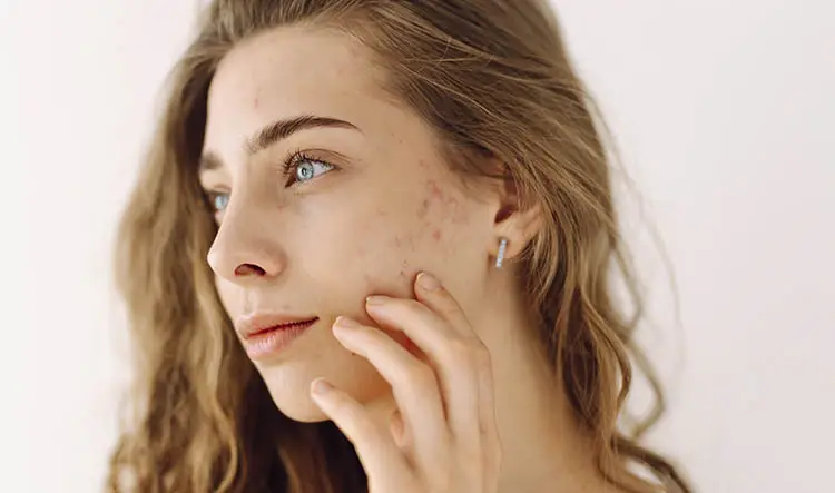 Застойные пятна от прыщей на лице: методы коррекции и предотвращения