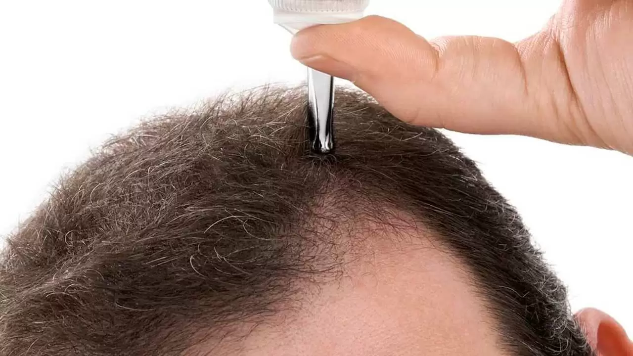 Выпадение волос у мужчин [в молодом возрасте] — причины, что делать