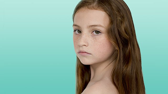 HUB_CONTENT_DHSC_FAQ_10_Can_children_dandruff