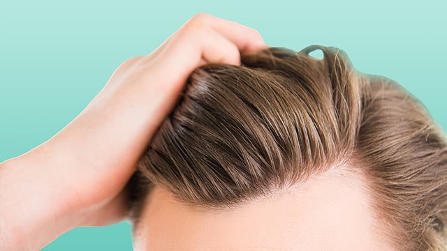 HUB_CONTENT_DHSC_FAQ_10_Can_children_dandruff