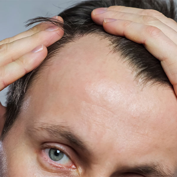 Причины алопеции у мужчин