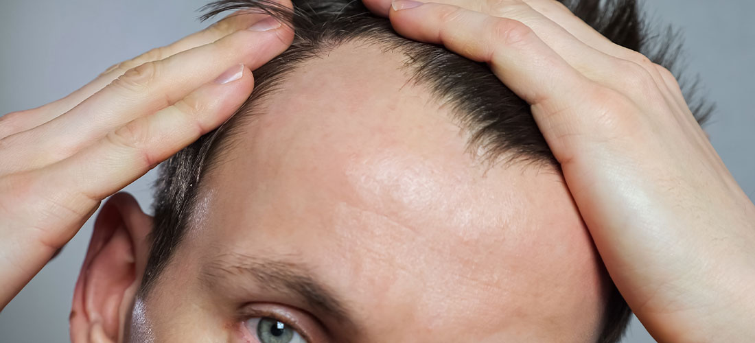 Причины алопеции у мужчин